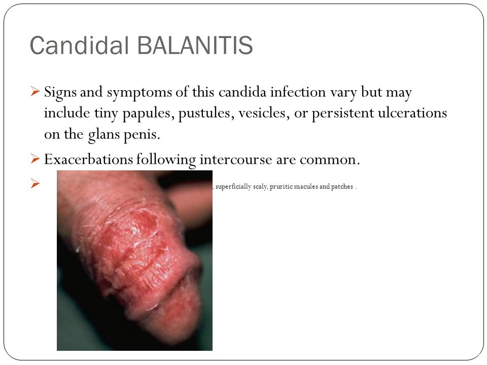 of penis candidiasis the